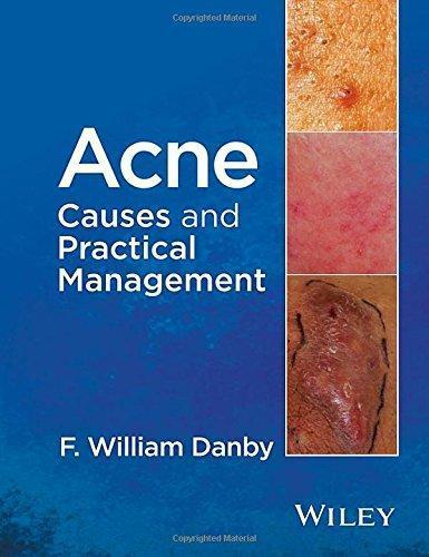 Acne Causes And Practical Management