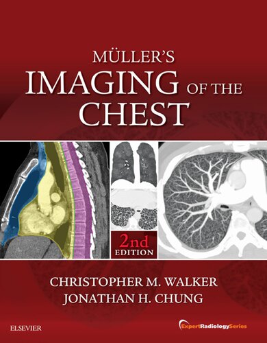 Muller's Imaging of the Chest E-Book : Expert Radiology Series