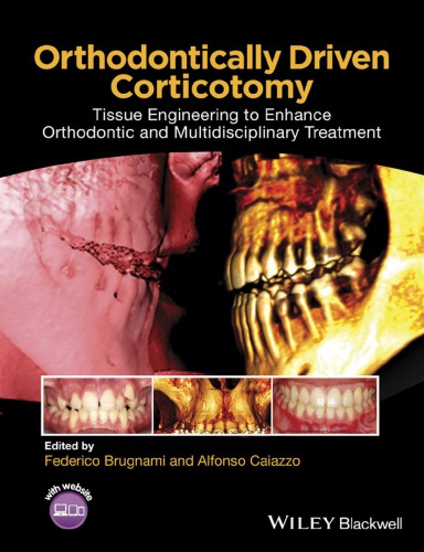 Orthodontically driven corticotomy: tissue engineering to enhance orthodontic and multidisciplinary treatment