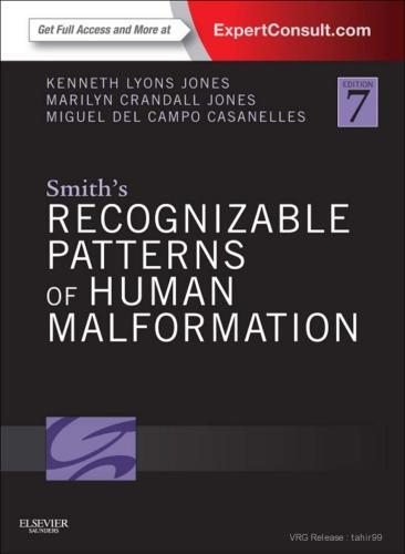 Smiths Recognizable Patterns Of Human Malformation 7Th Edition