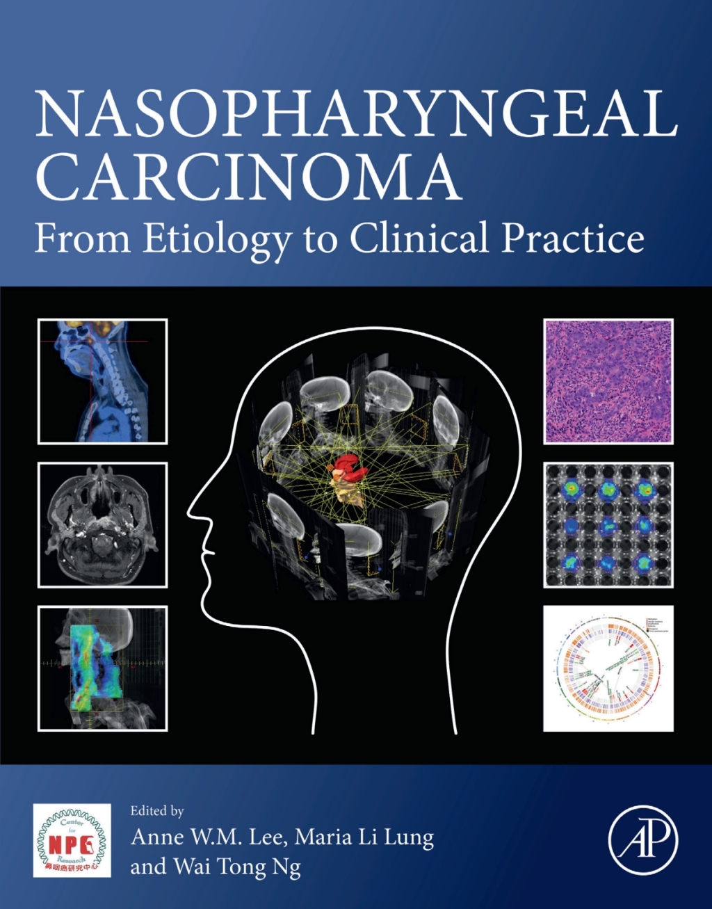 Nasopharyngeal Carcinoma From Etiology to Clinical Practice 