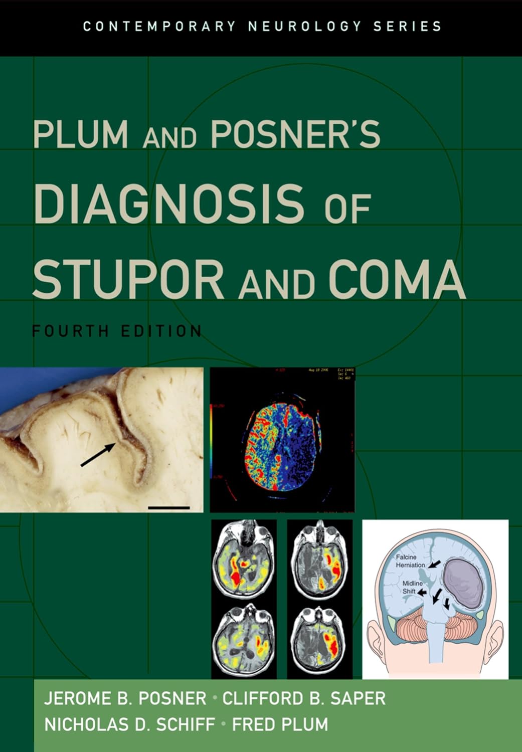 Plum and Posner's Diagnosis of Stupor and Coma (Contemporary Neurology Series Book 71) (PDF/EPUB Version)