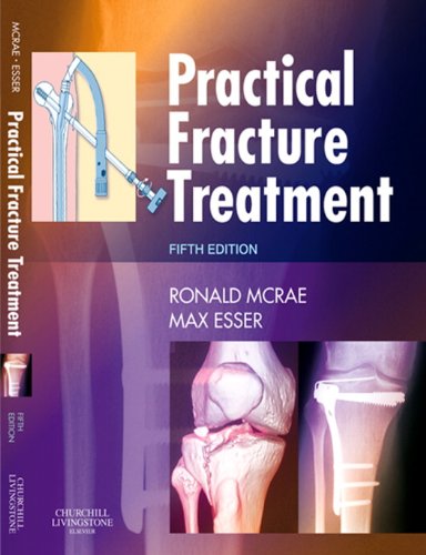 Practical Fracture Treatment E-Book (PDF/EPUB Version)