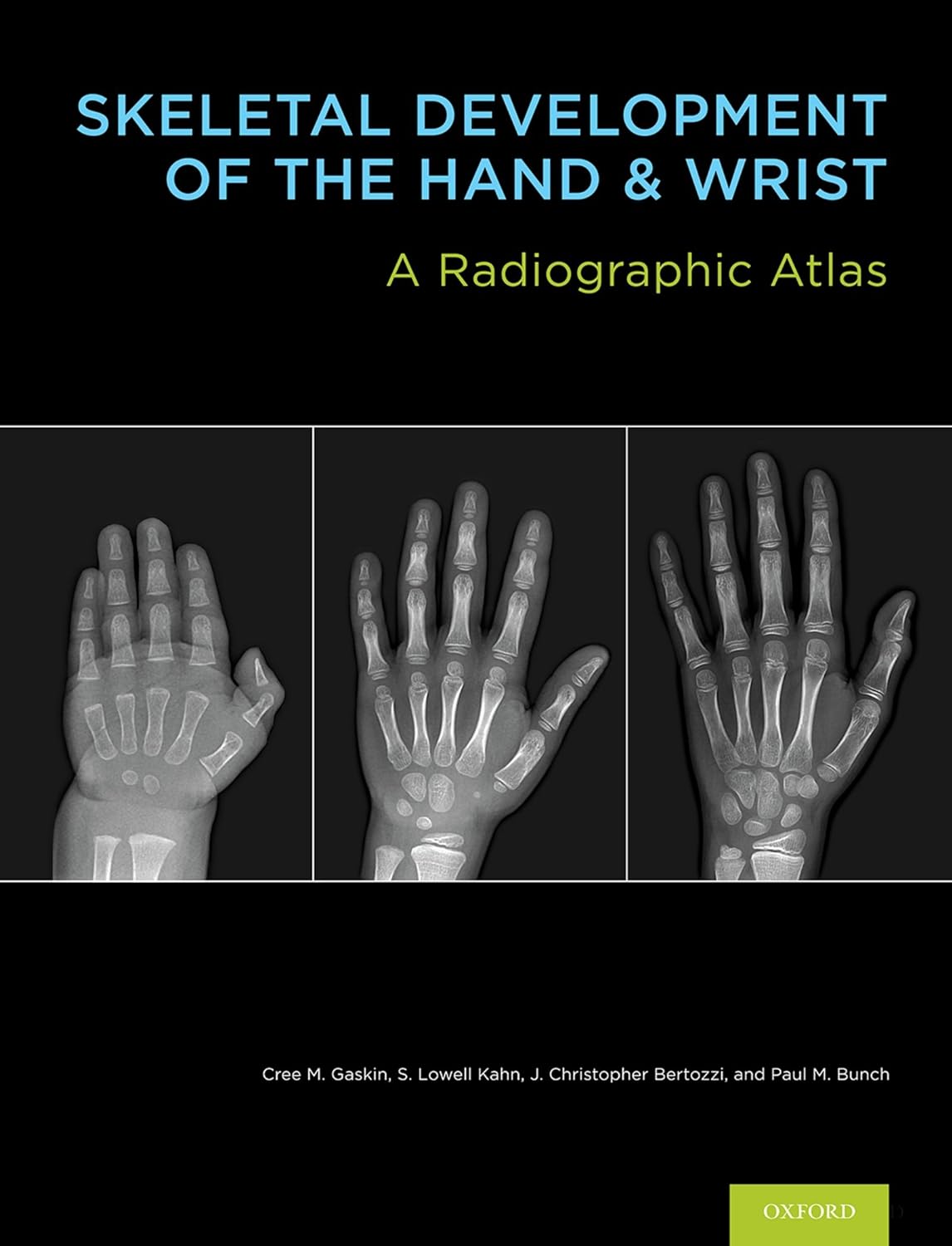 Skeletal Development of the Hand and Wrist: A Radiographic Atlas and Digital Bone Age Companion (PDF/EPUB Version)