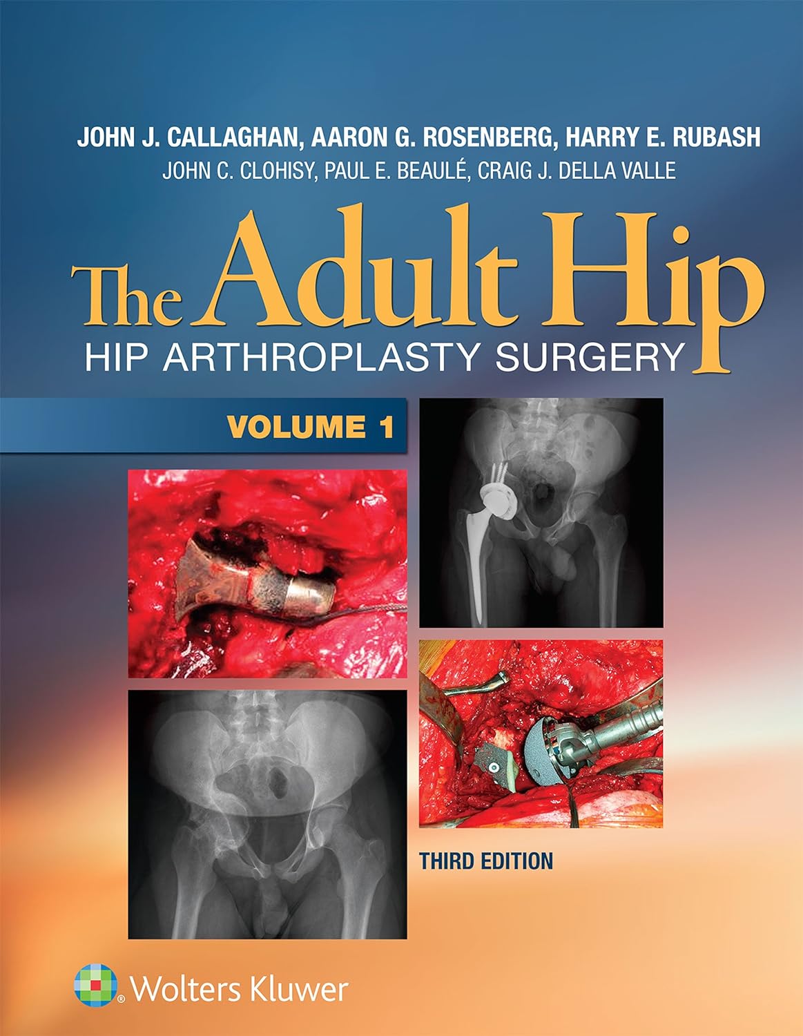 The Adult Hip: Hip Arthroplasty Surgery (PDF/EPUB Version)