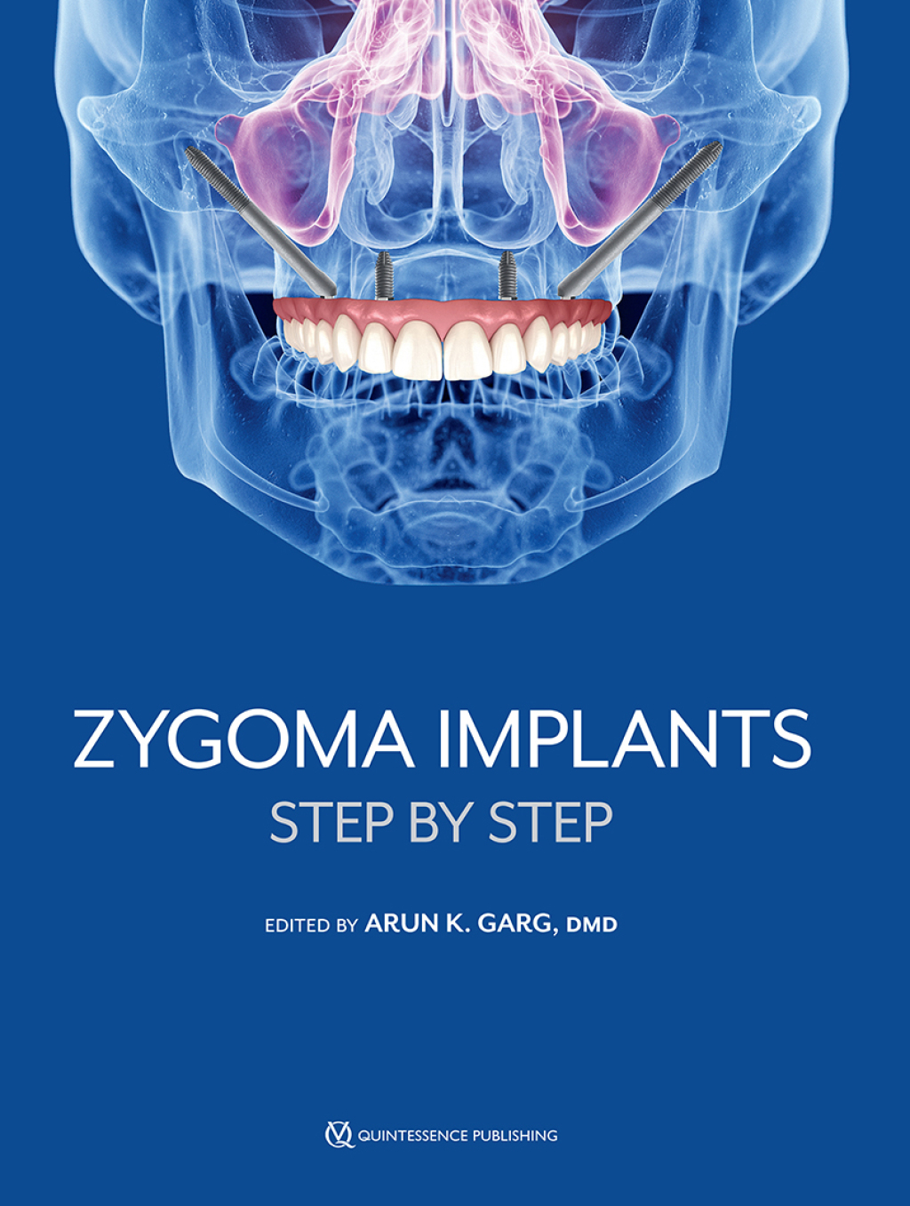 Zygoma Implants: Step by Step 1st Edition