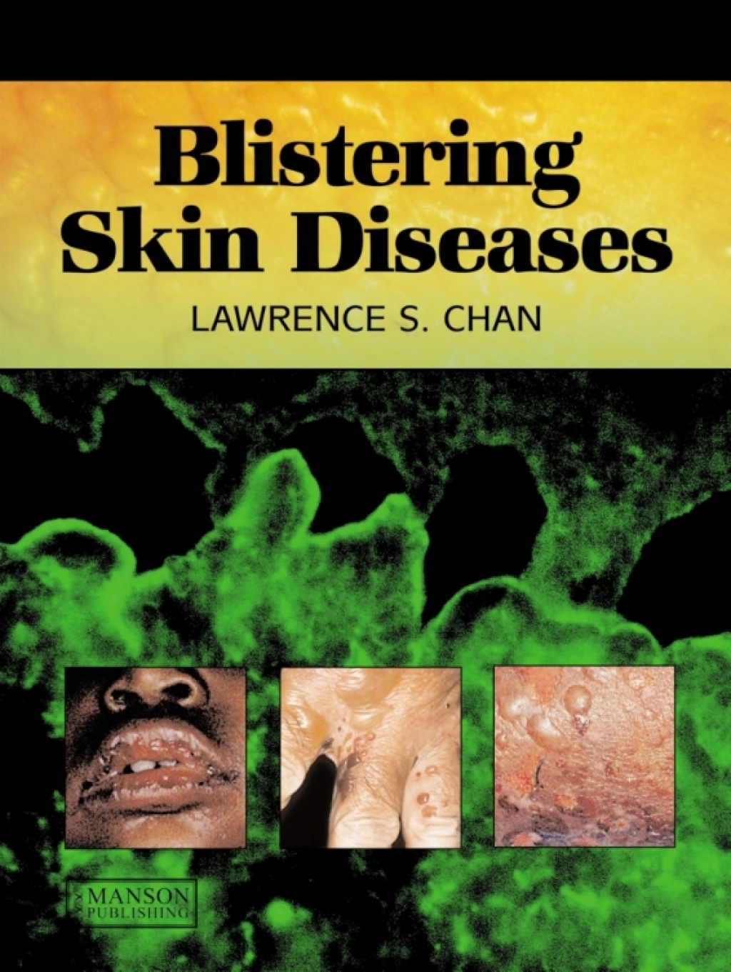 Blistering Skin Diseases 1st Edition