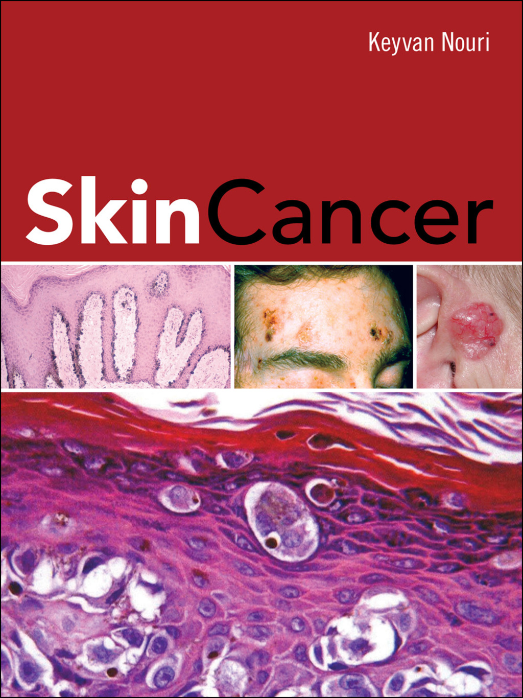 Skin Cancer 1st Edition