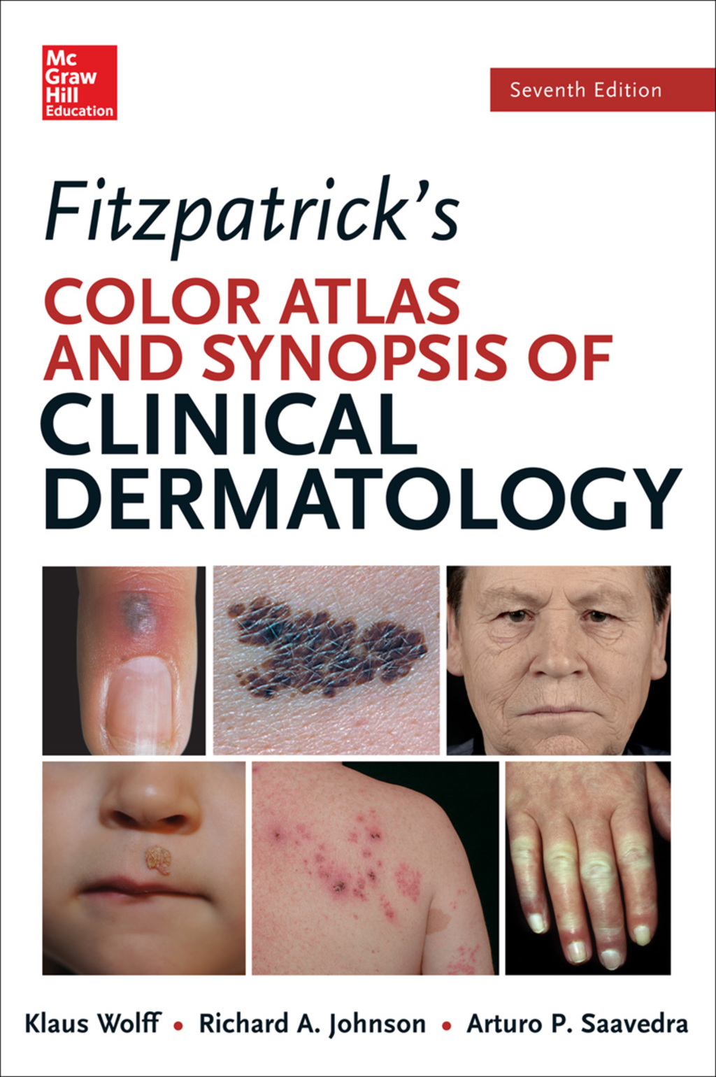 Fitzpatrick's Color Atlas and Synopsis of Clinical Dermatology 1st Edition