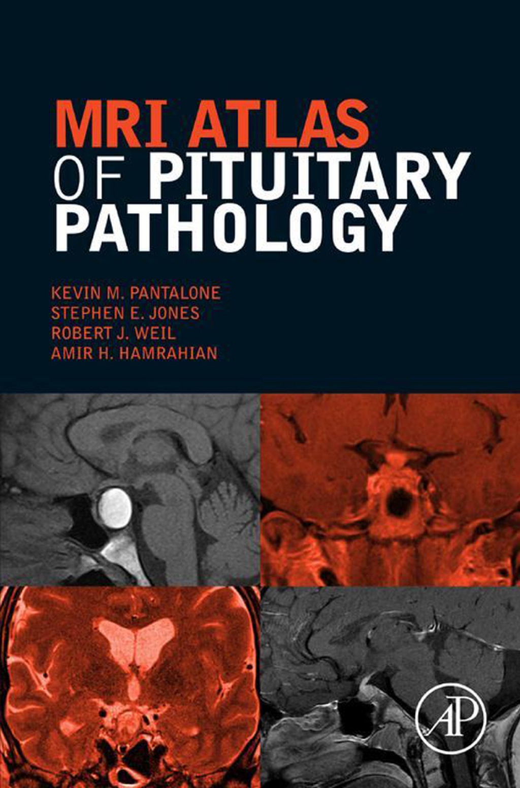 MRI Atlas of Pituitary Pathology 