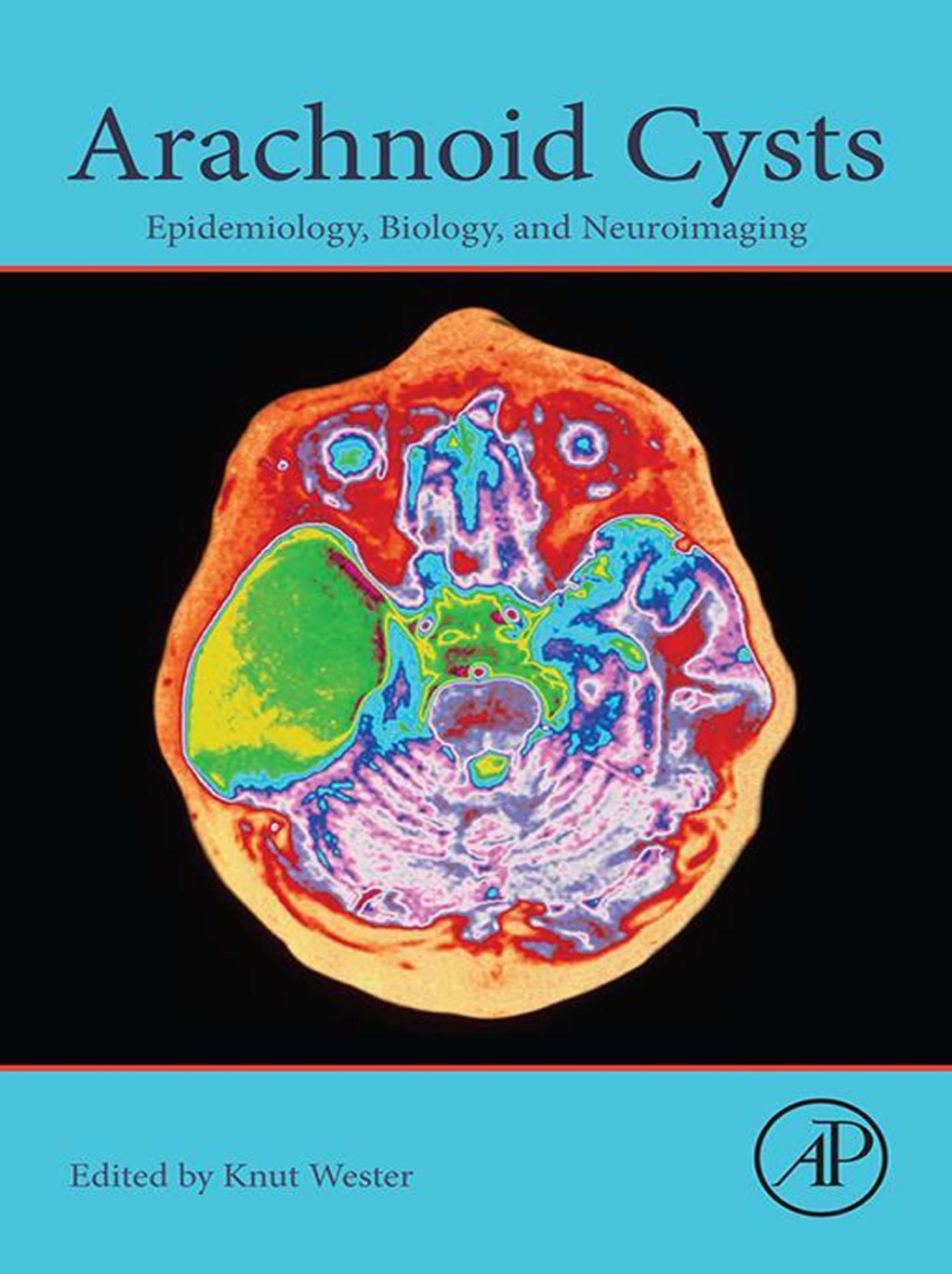 Arachnoid Cysts Epidemiology, Biology, and Neuroimaging 