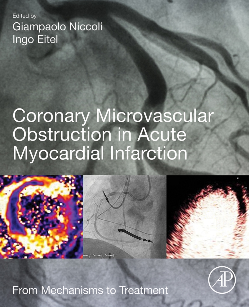 Coronary Microvascular Obstruction in Acute Myocardial Infarction From Mechanisms to Treatment 