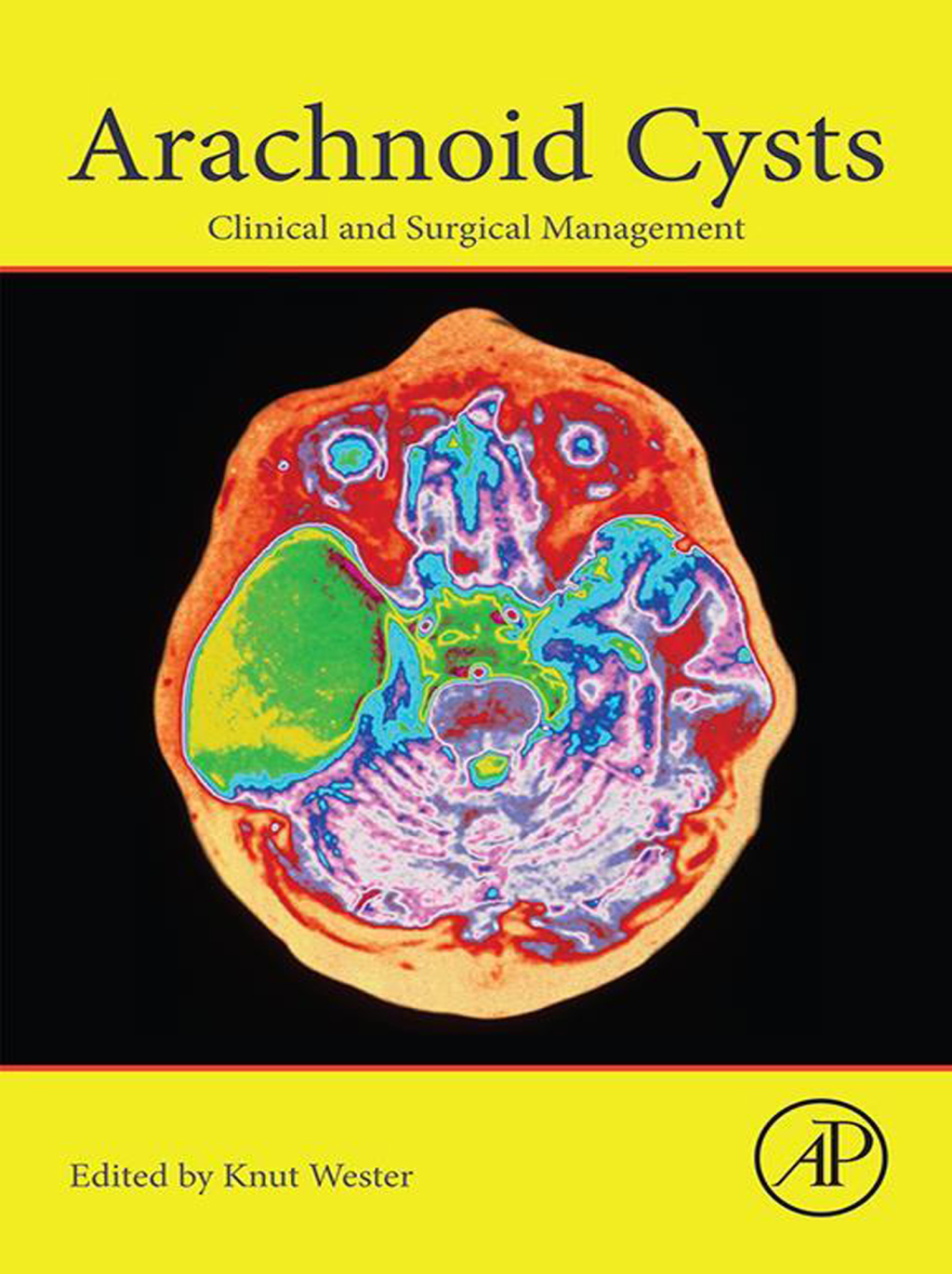 Arachnoid Cysts Clinical and Surgical Management 