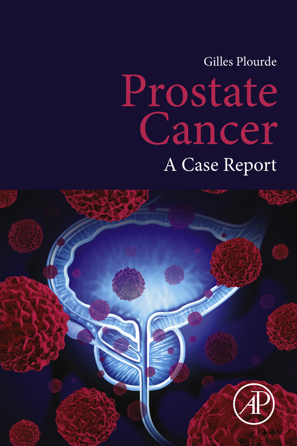 Prostate Cancer A Case Report 
