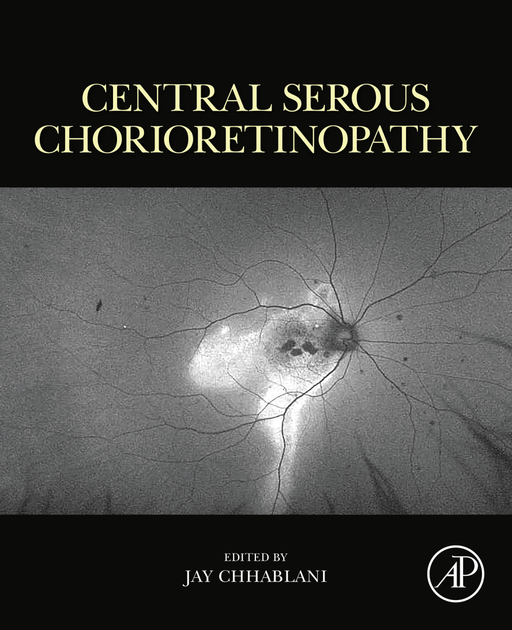 Central Serous Chorioretinopathy 