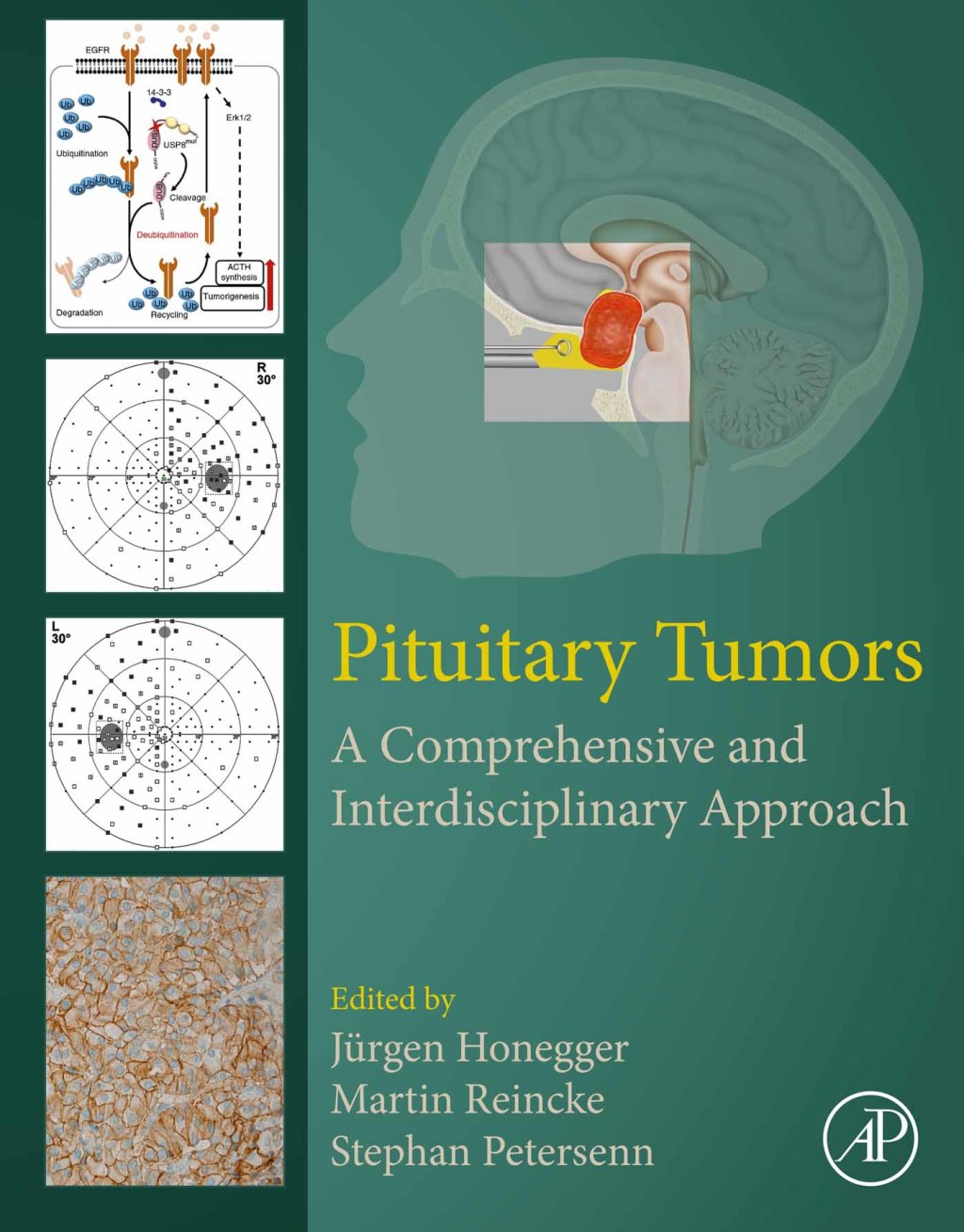 Pituitary Tumors A Comprehensive and Interdisciplinary Approach 