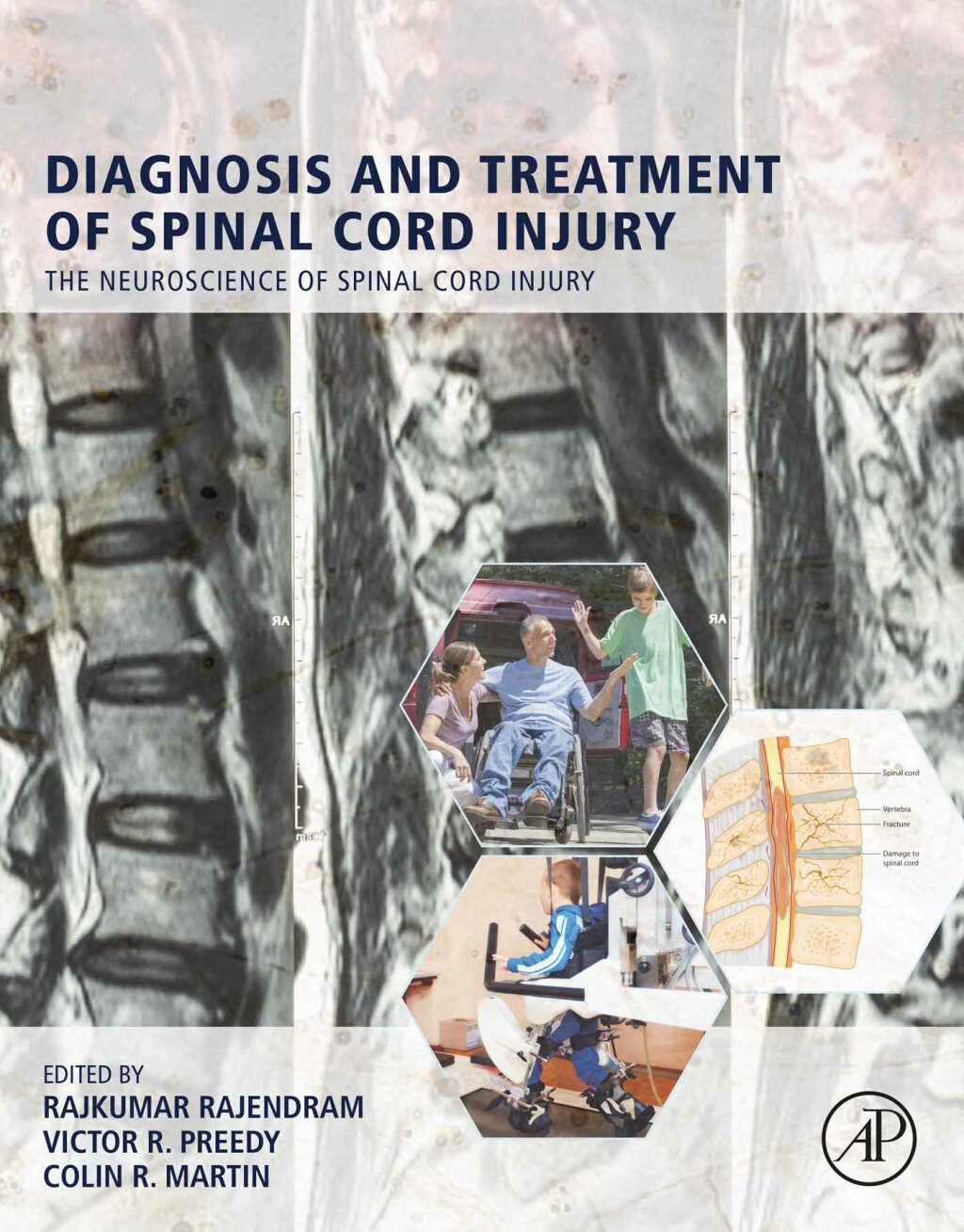 Diagnosis and Treatment of Spinal Cord Injury 