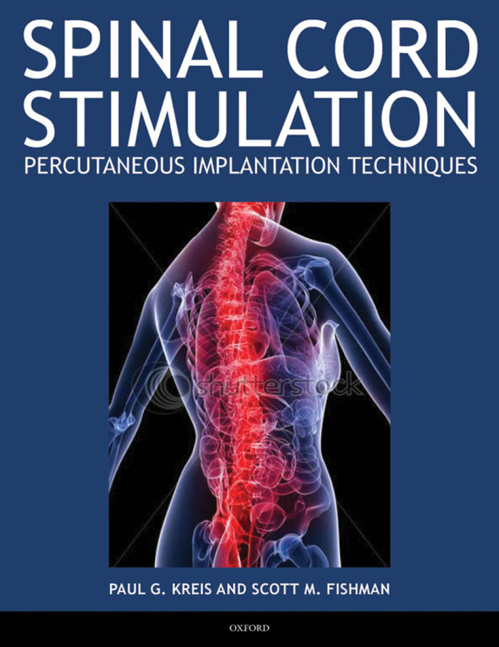 Spinal Cord Stimulation Percutaneous Implantation Techniques 