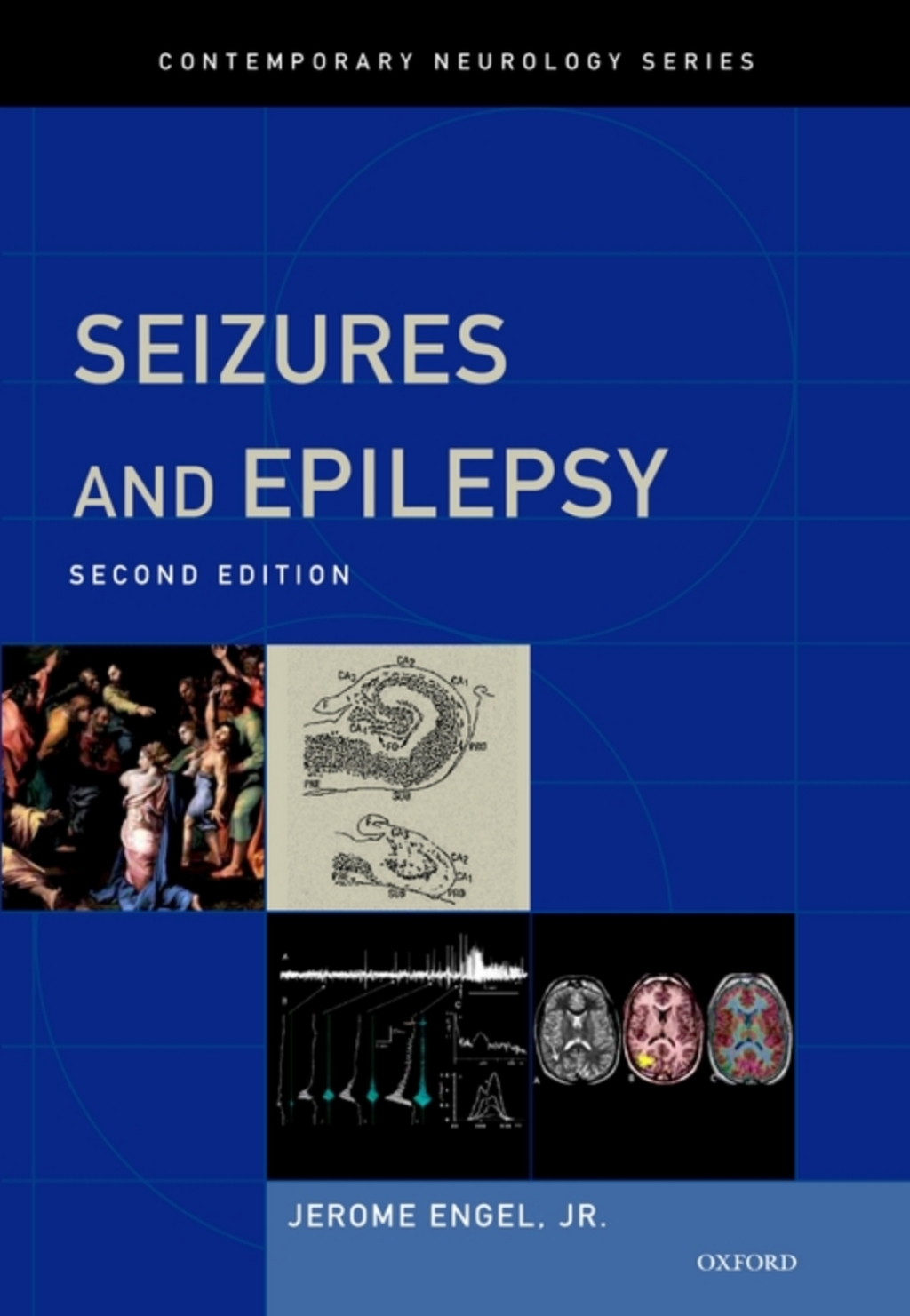 Seizures and Epilepsy 2nd Edition