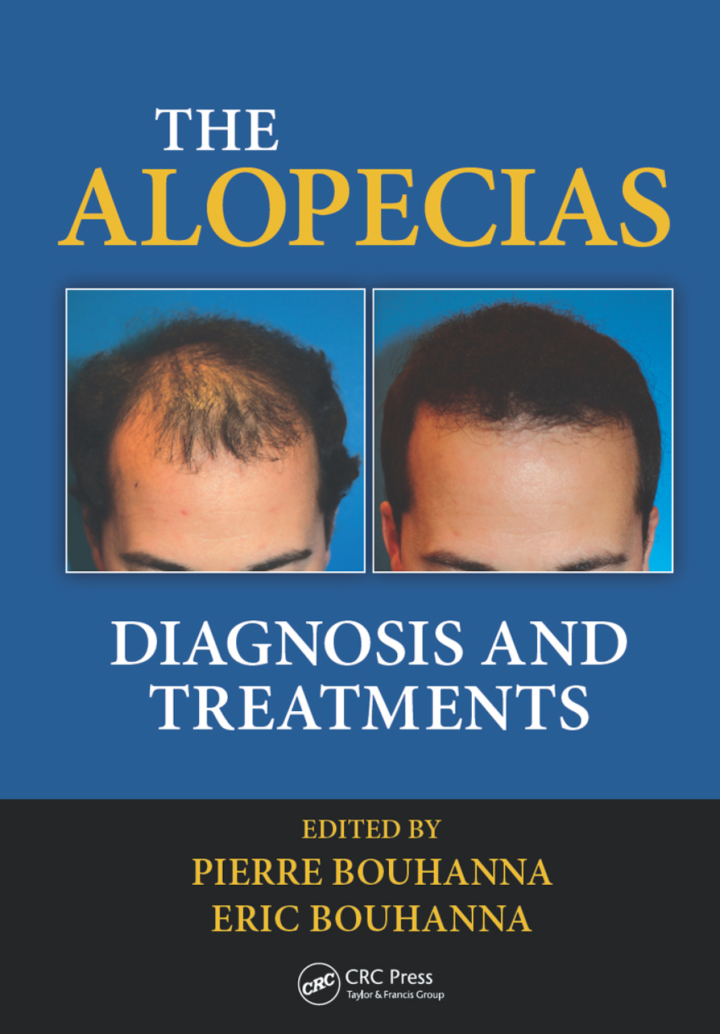 The Alopecias Diagnosis and Treatments 1st Edition