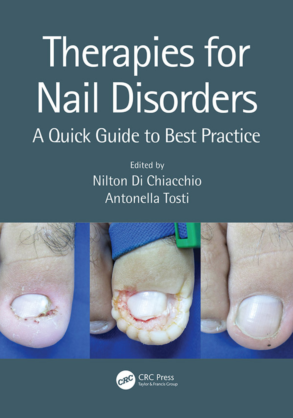 Therapies for Nail Disorders A Quick Guide to Best Practice 1st Edition