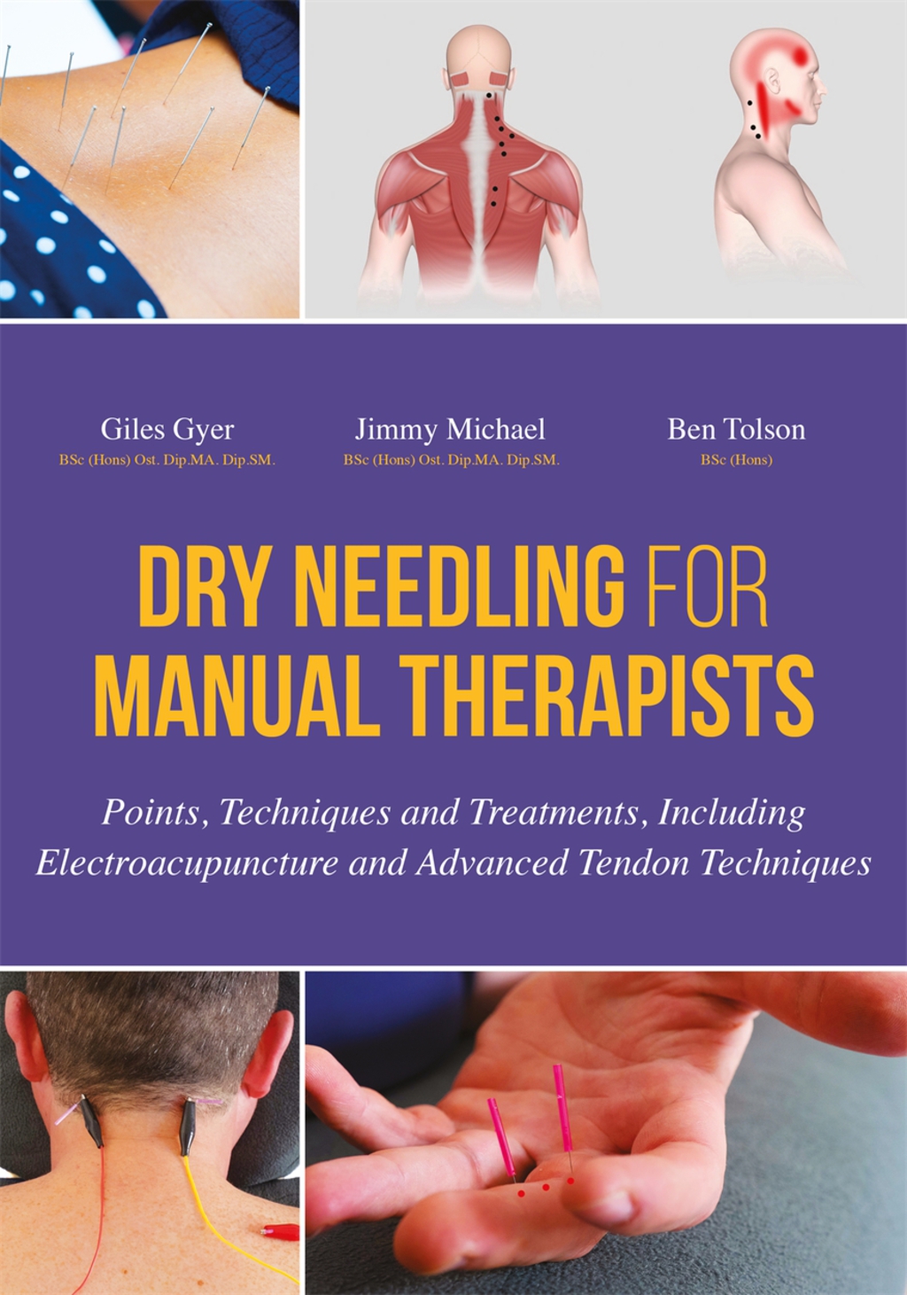 Dry Needling for Manual Therapists Points, Techniques and Treatments, Including Electroacupuncture and Advanced Tendon Techniques 
