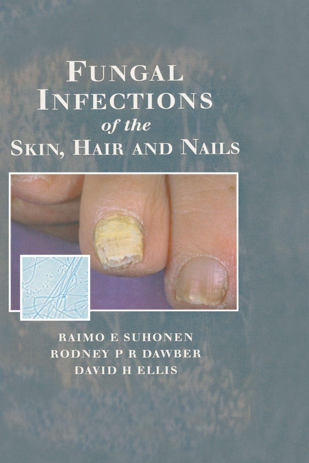 Fungal Infections of the Skin and Nails 1st Edition