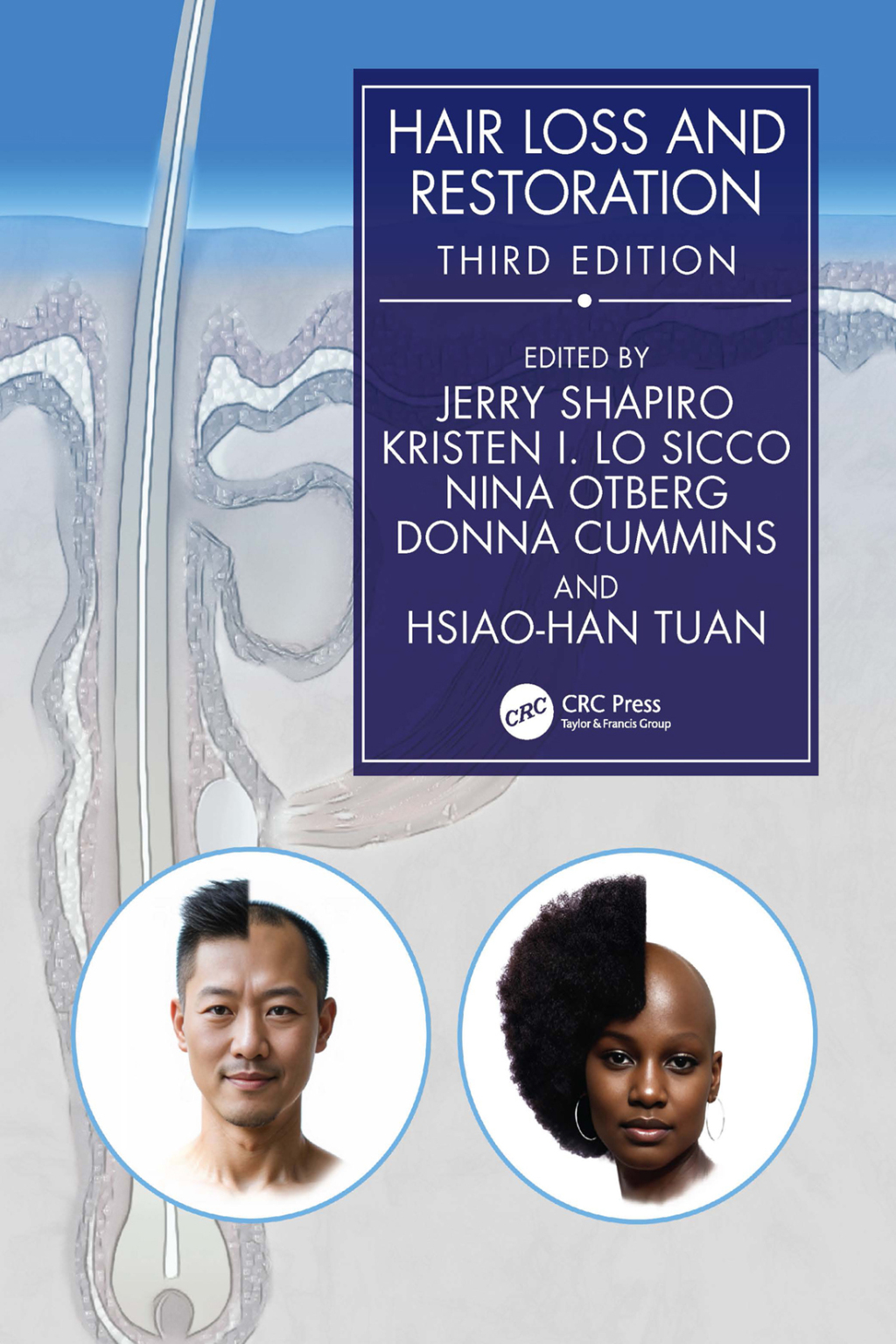 Hair Loss and Restoration 3rd Edition