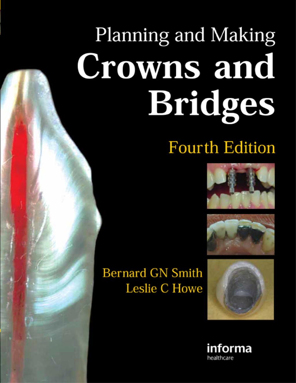 Planning and Making Crowns and Bridges 4th Edition