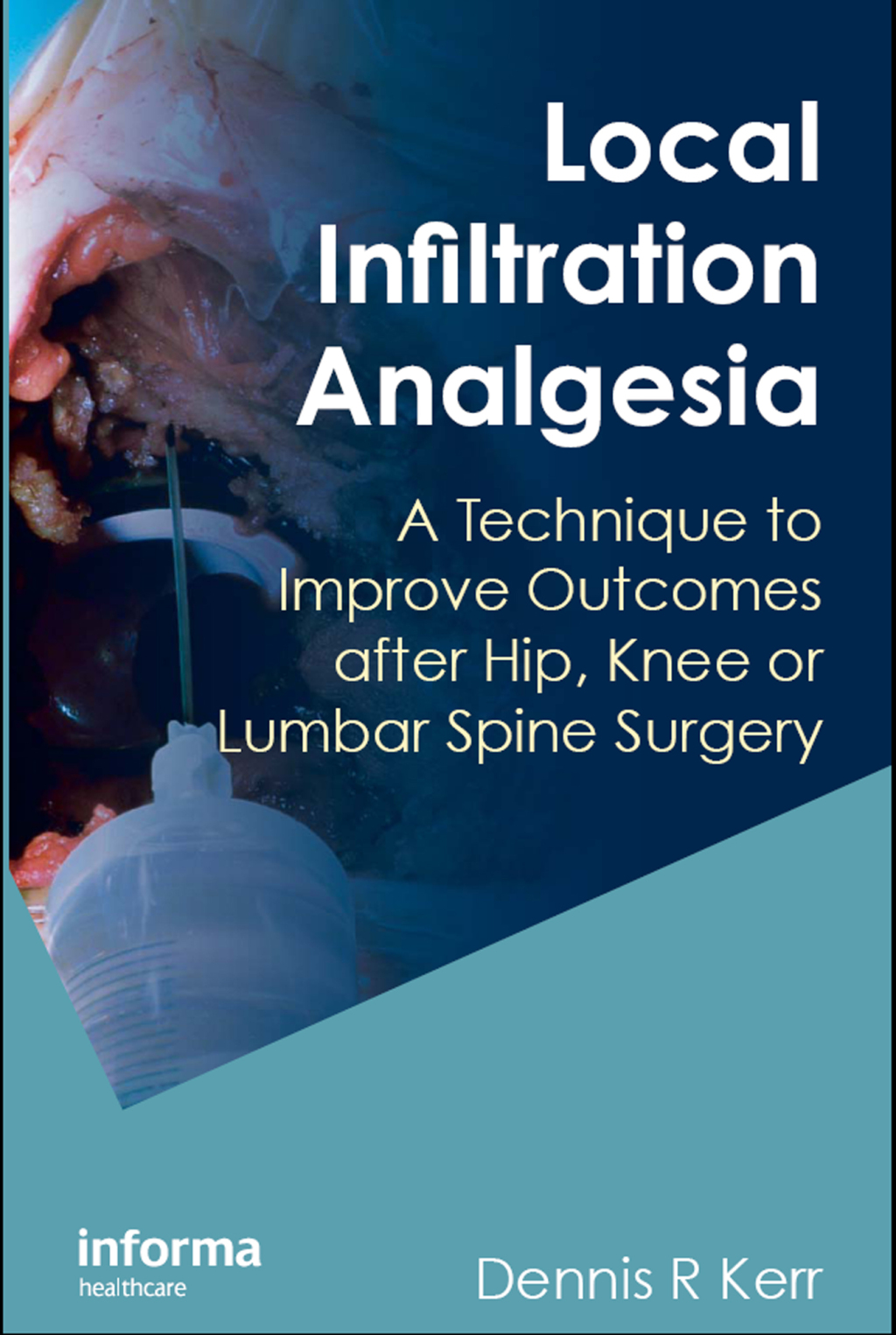 Local Infiltration Analgesia A Technique to Improve Outcomes after Hip, Knee or Lumbar Spine Surgery 1st Edition