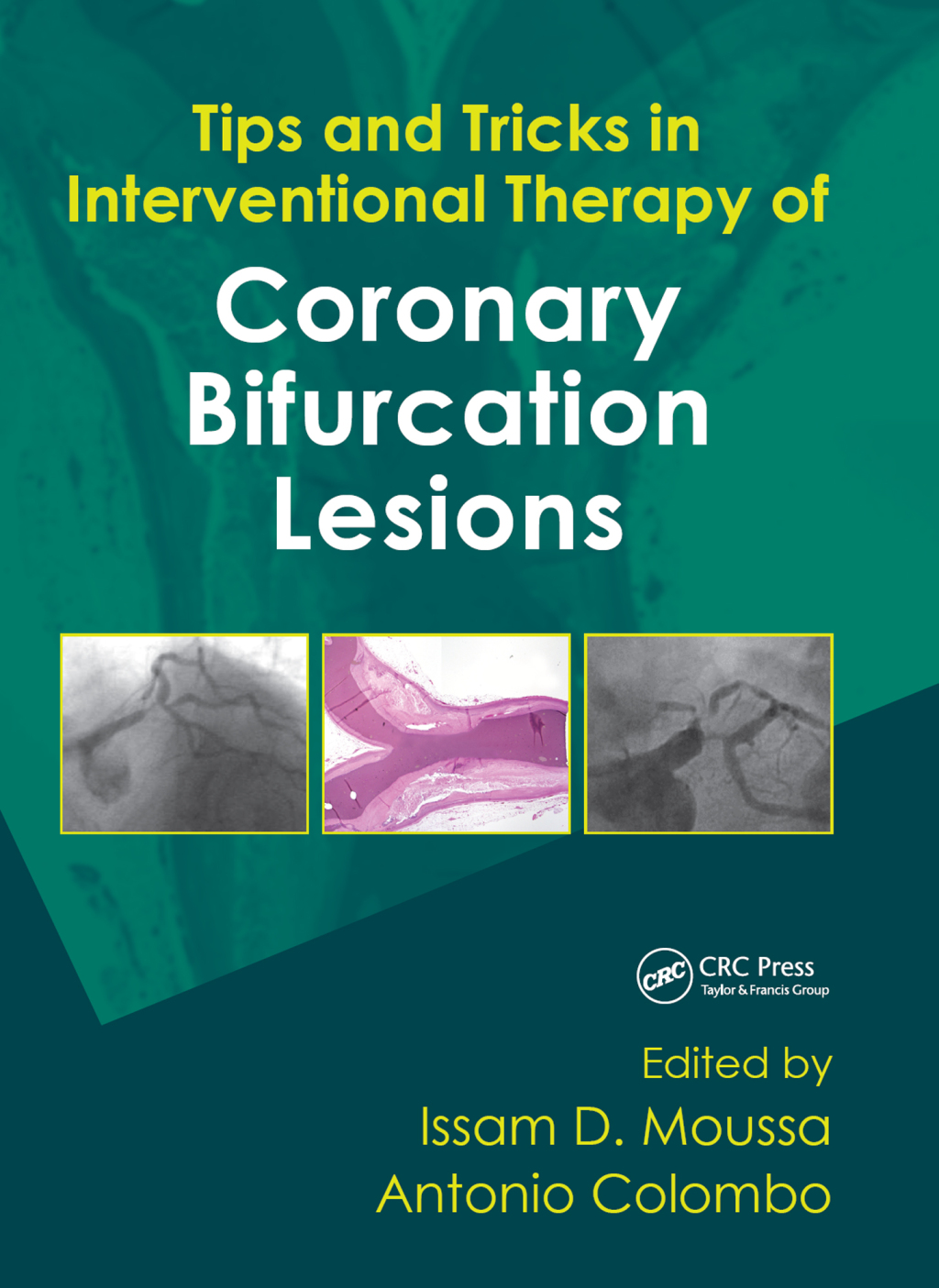 Tips and Tricks in Interventional Therapy of Coronary Bifurcation Lesions 1st Edition