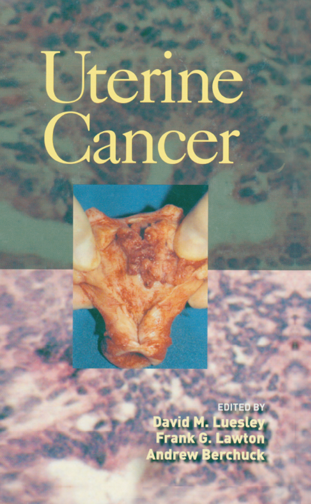 Uterine Cancer 1st Edition