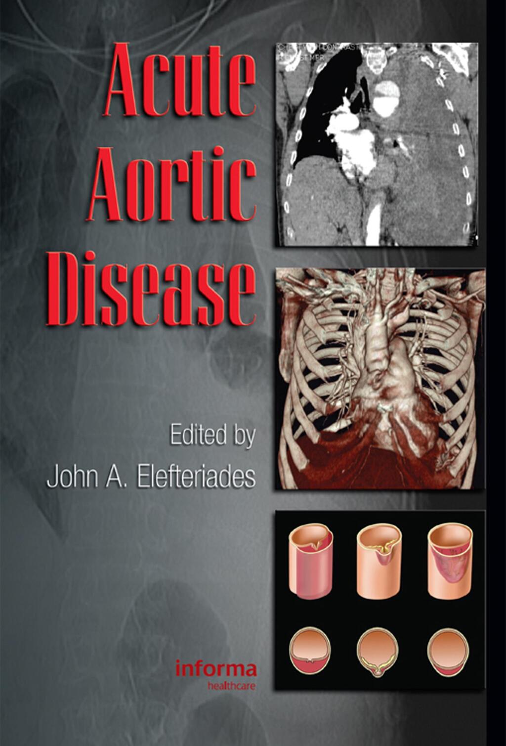 Acute Aortic Disease 1st Edition