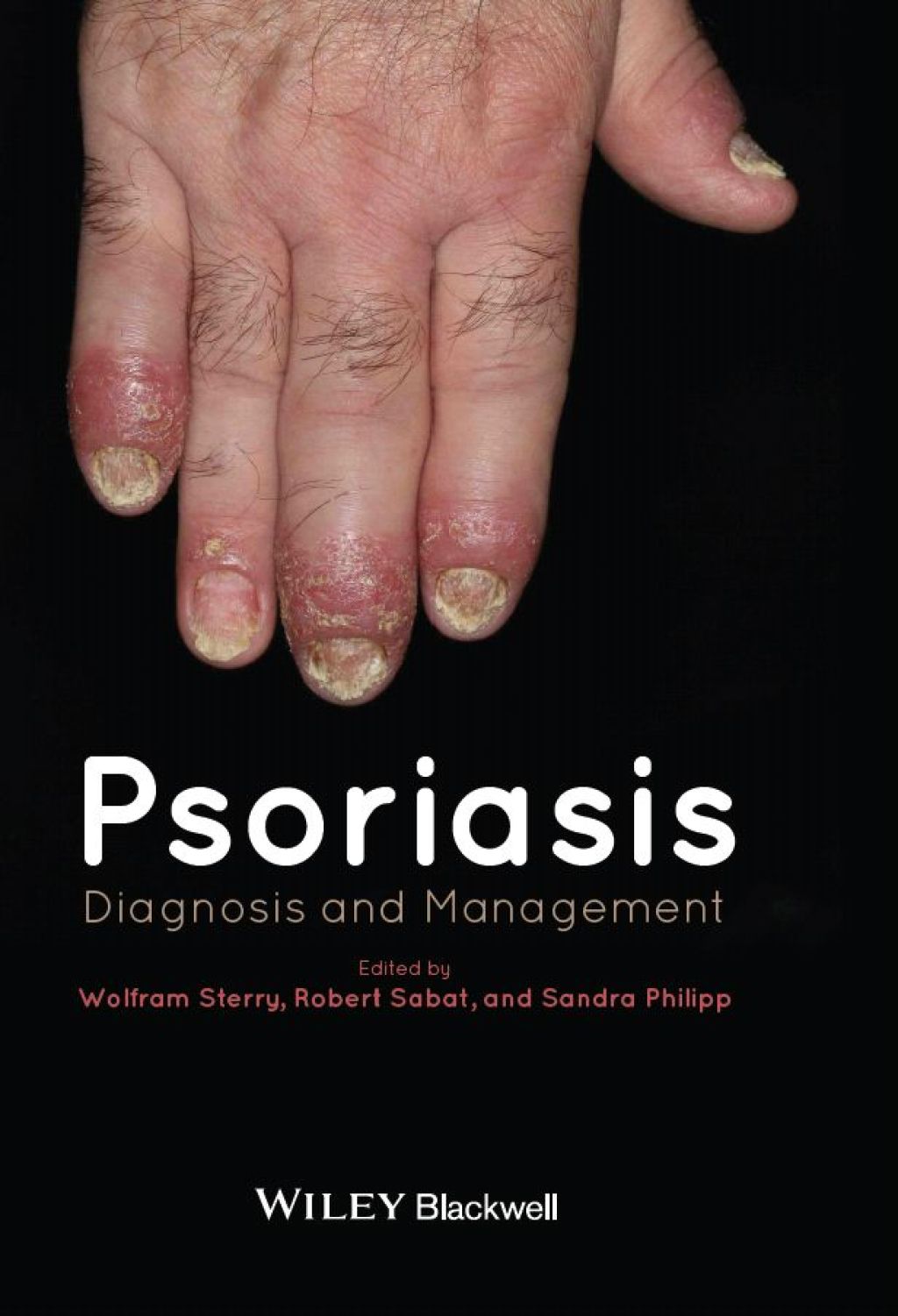 Psoriasis: Diagnosis and Management Diagnosis and Management 1st Edition