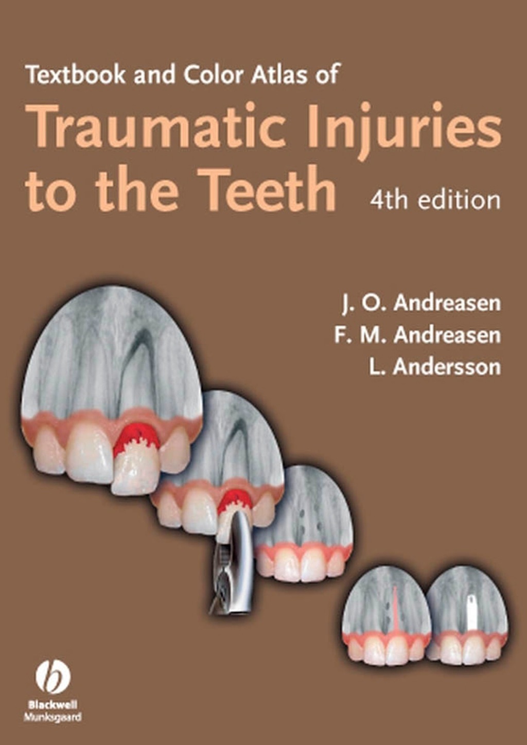 Textbook and Color Atlas of Traumatic Injuries to the Teeth 4th Edition