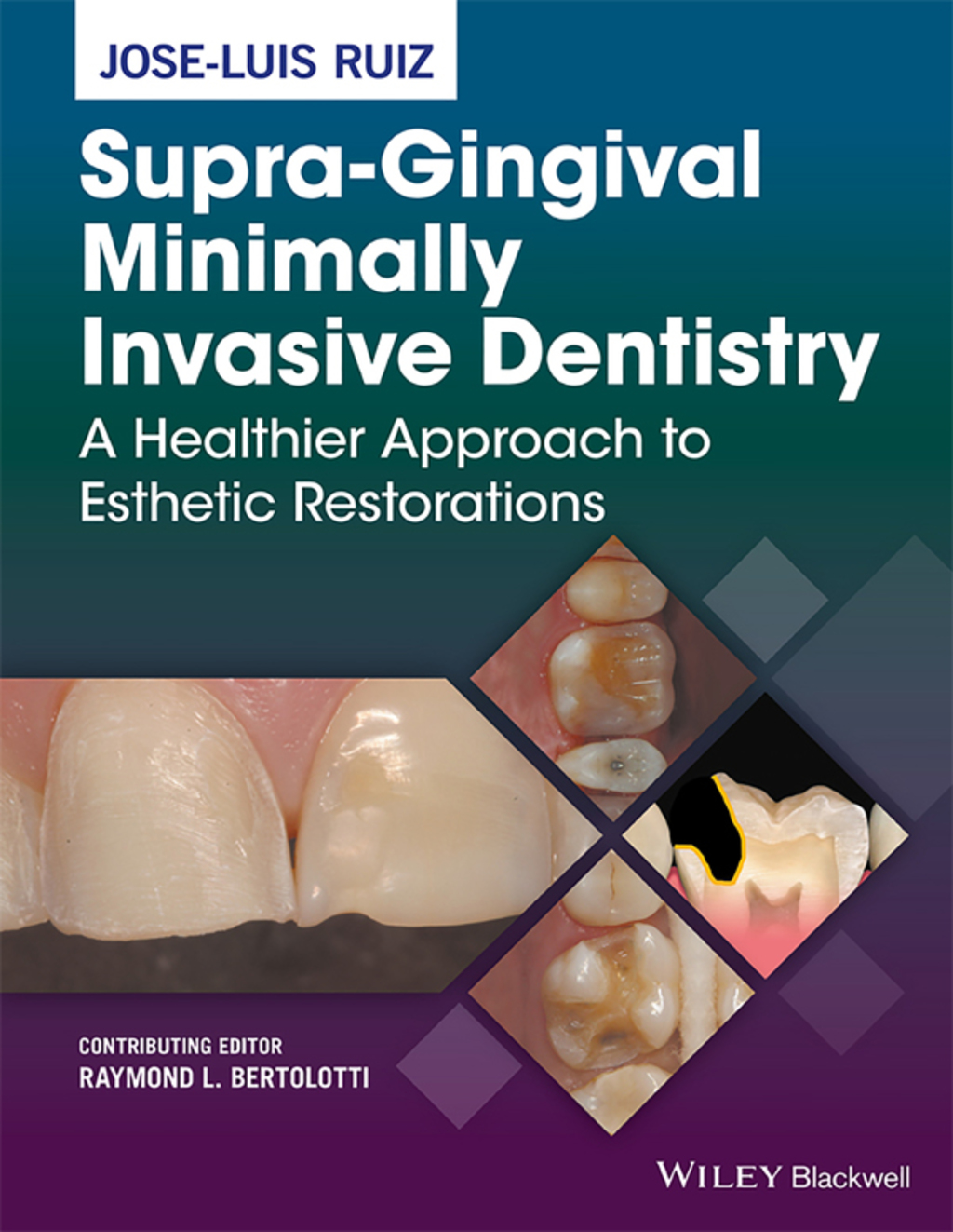 Supra-Gingival Minimally Invasive Dentistry: A Healthier Approach to Esthetic Restorations 1st Edition