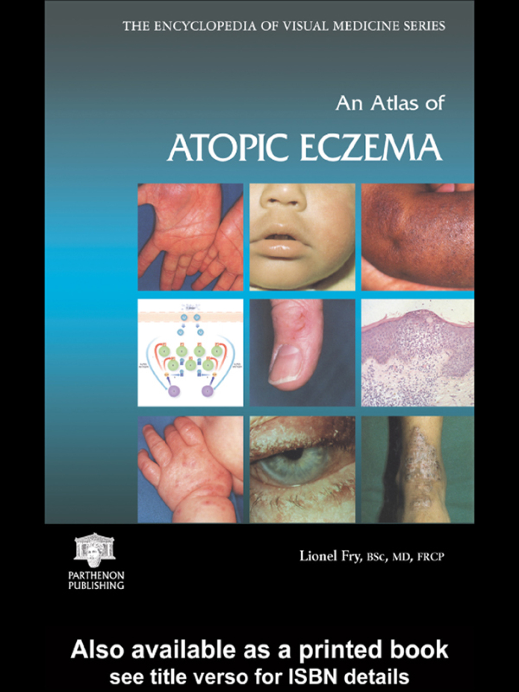 An Atlas of Atopic Eczema 1st Edition