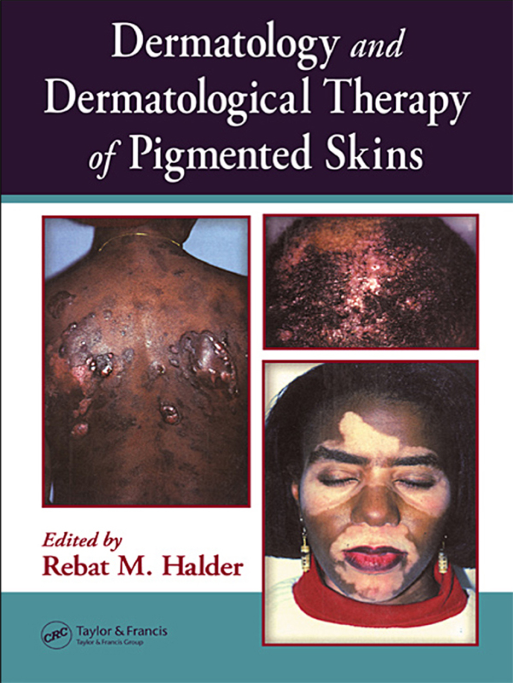 Dermatology and Dermatological Therapy of Pigmented Skins 1st Edition