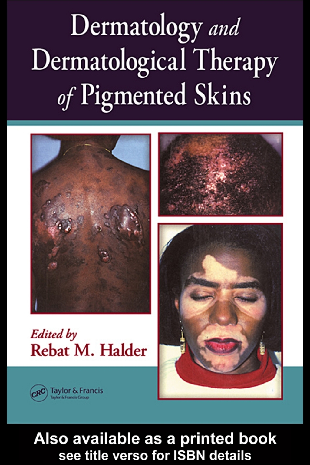 Dermatology and Dermatological Therapy of Pigmented Skins 1st Edition