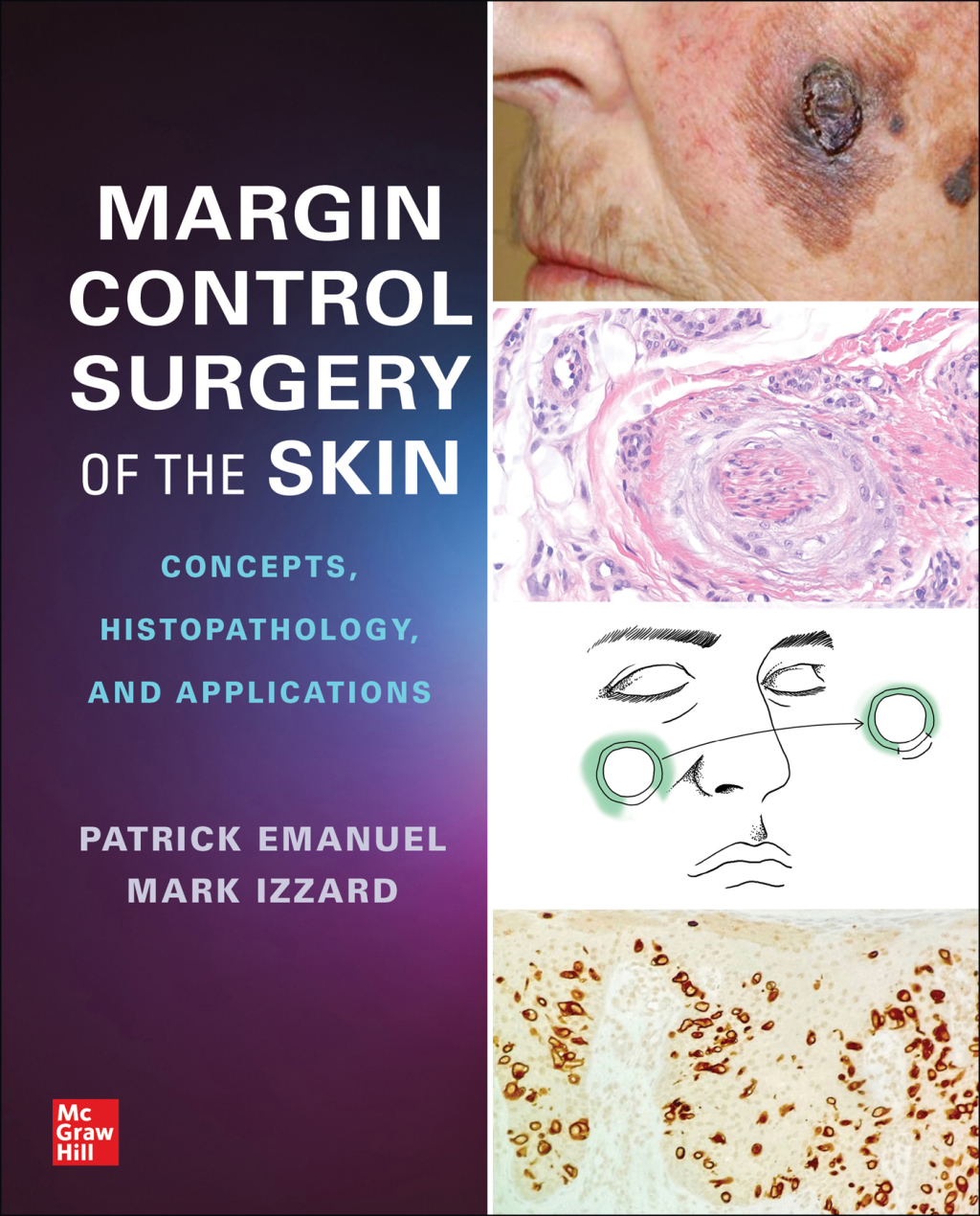 Margin Control Surgery of the Skin: Concepts, Histopathology, and Applications 1st Edition