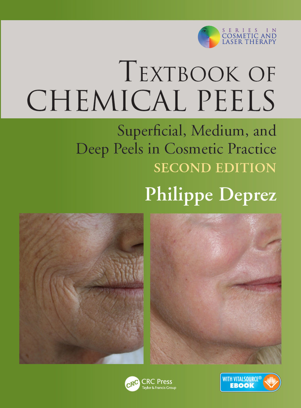 Textbook of Chemical Peels Superficial, Medium, and Deep Peels in Cosmetic Practice 2nd Edition