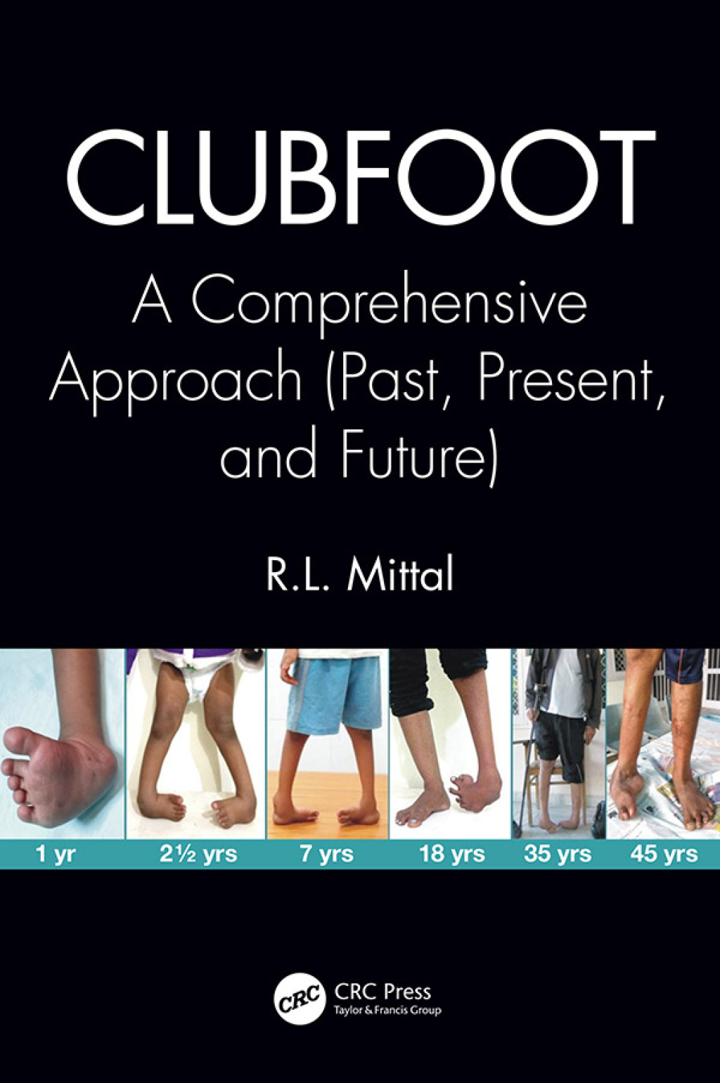 Clubfoot A Comprehensive Approach (Past, Present, and Future) 1st Edition