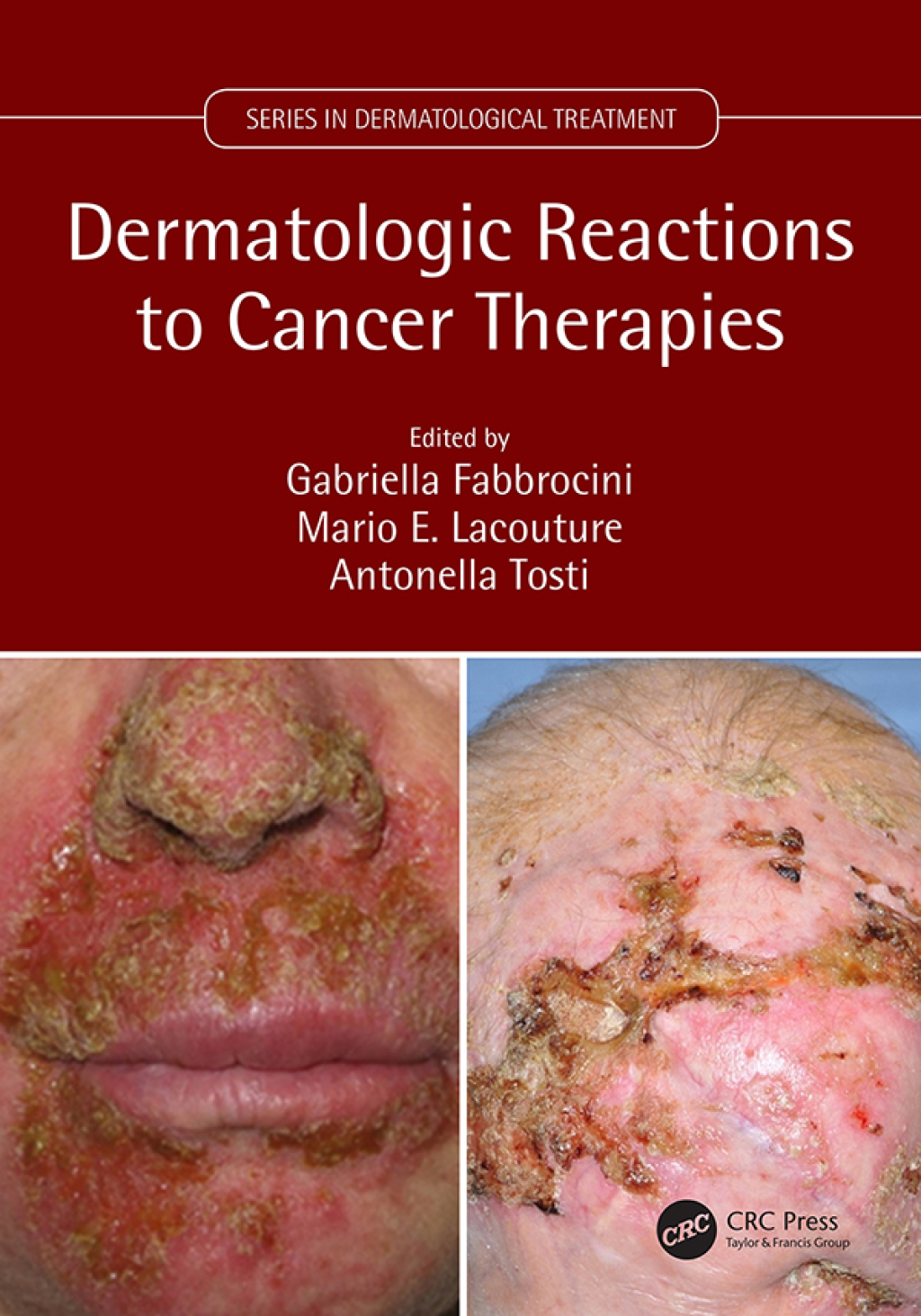 Dermatologic Reactions to Cancer Therapies 1st Edition