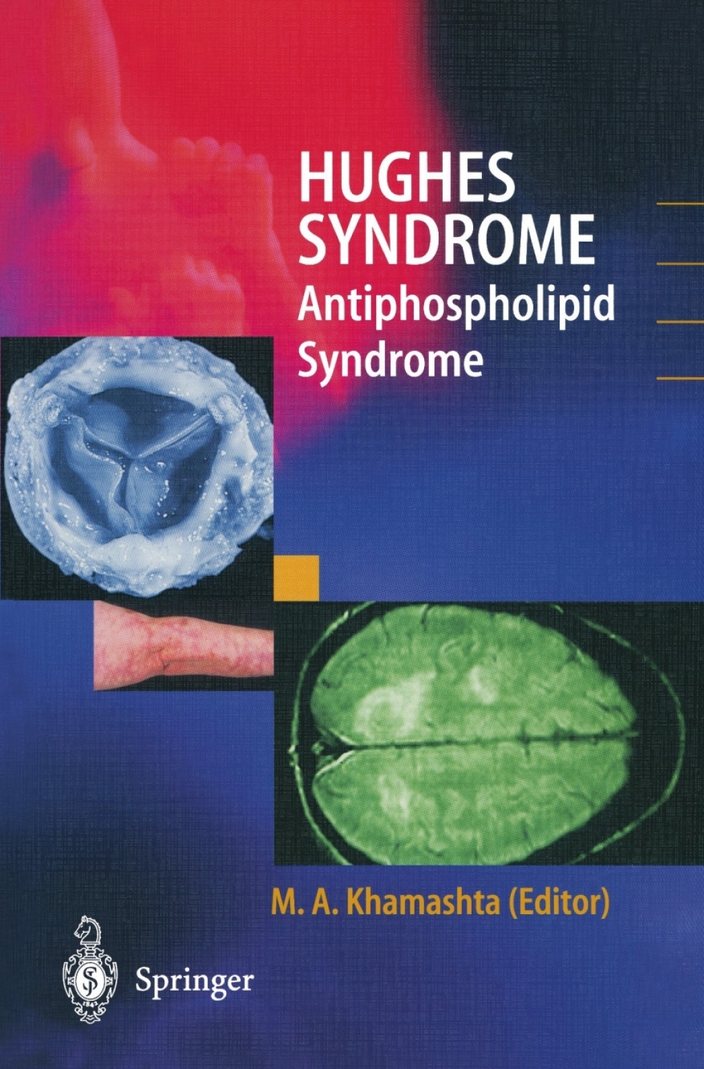 Hughes Syndrome Antiphospholipid Syndrome 1st Edition