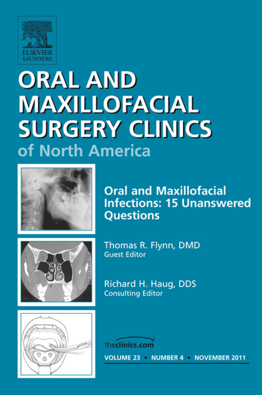 Unanswered Questions in Oral and Maxillofacial Infections, An Issue of Oral and Maxillofacial Surgery Clinics 