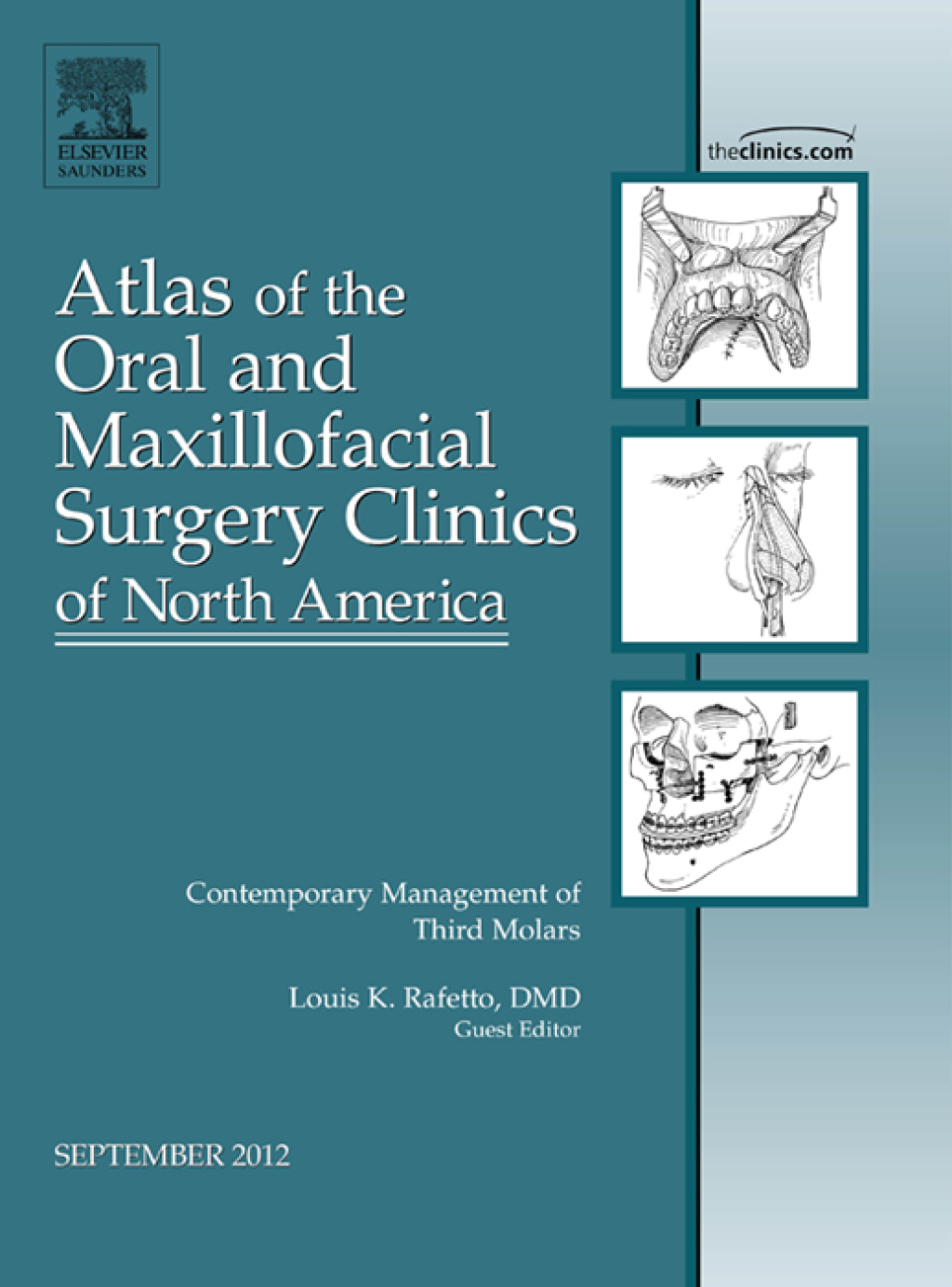 Contemporary Management of Third Molars, An Issue of Atlas of the Oral and Maxillofacial Surgery Clinics 