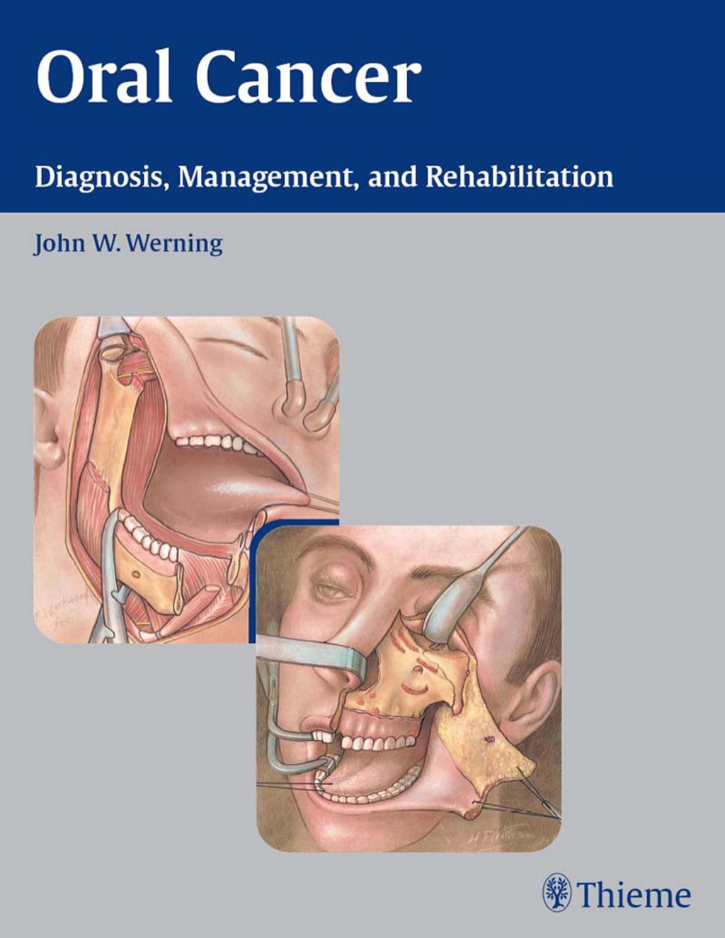 Oral Cancer Diagnosis, Management, and Rehabilitation 1st Edition