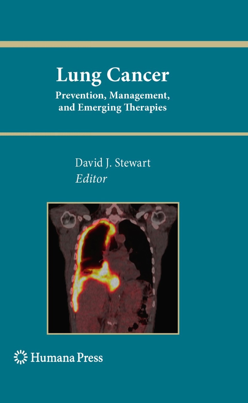 Lung Cancer: Prevention, Management, and Emerging Therapies 1st Edition