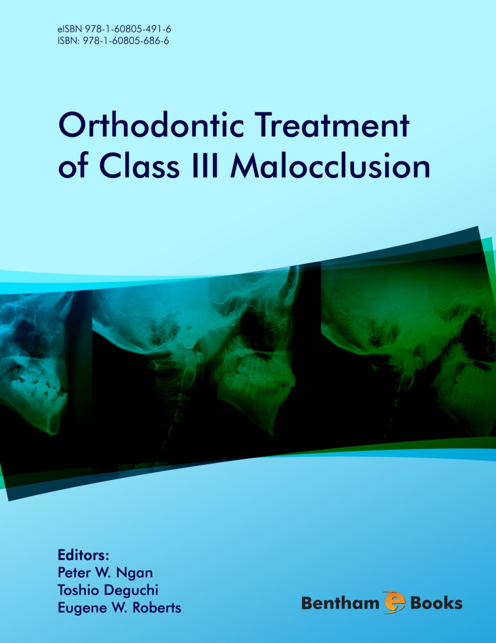 Orthodontic Treatment of Class III Malocclusion 1st Edition