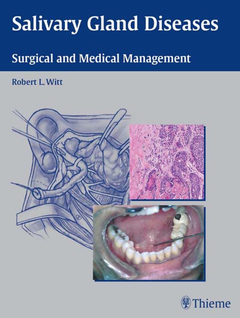 Salivary Gland Diseases Surgical and Medical Management 1st Edition